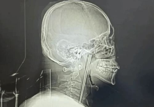 Yemək çubuğunu udan kişi 8 il həkimə getməyib 