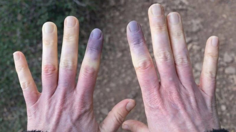 Sadəcə üşüdüyünüzü düşünməyin:  Əlləriniz göyərirsə...