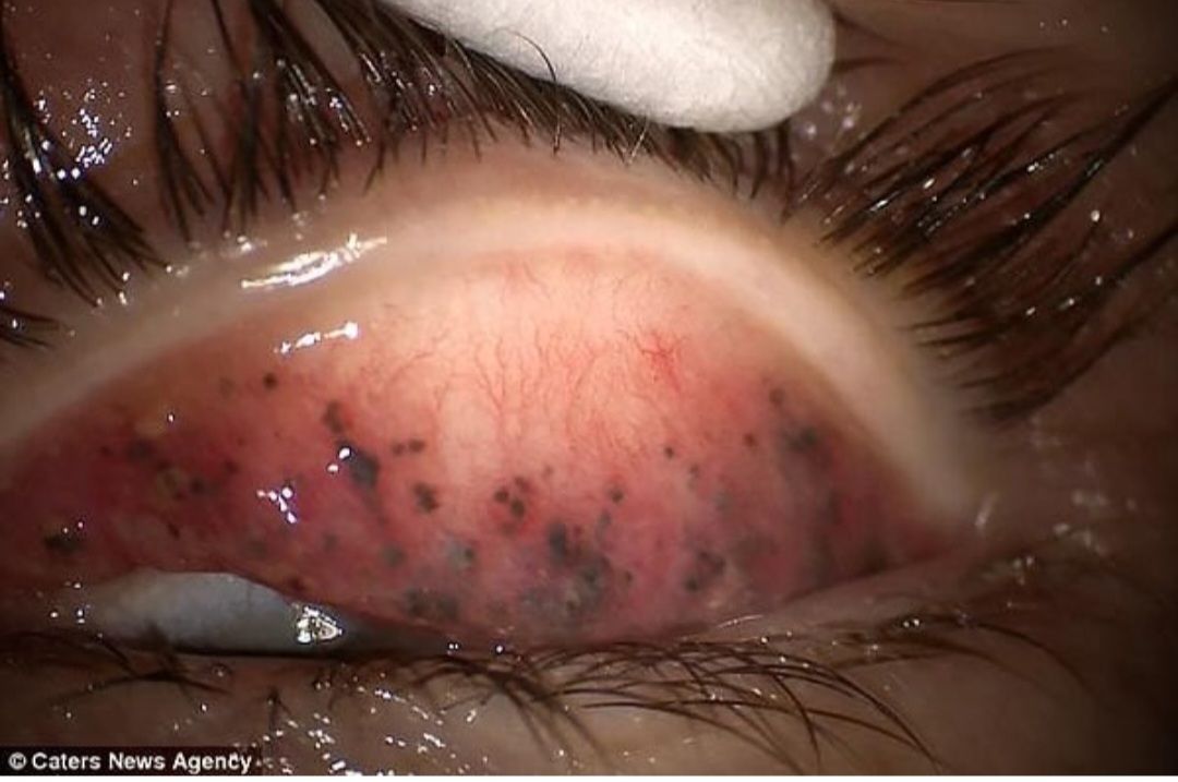 Makiyajı silmədən yatan qadının gözü -  Mütəxəssisdən xəbərdarlıq