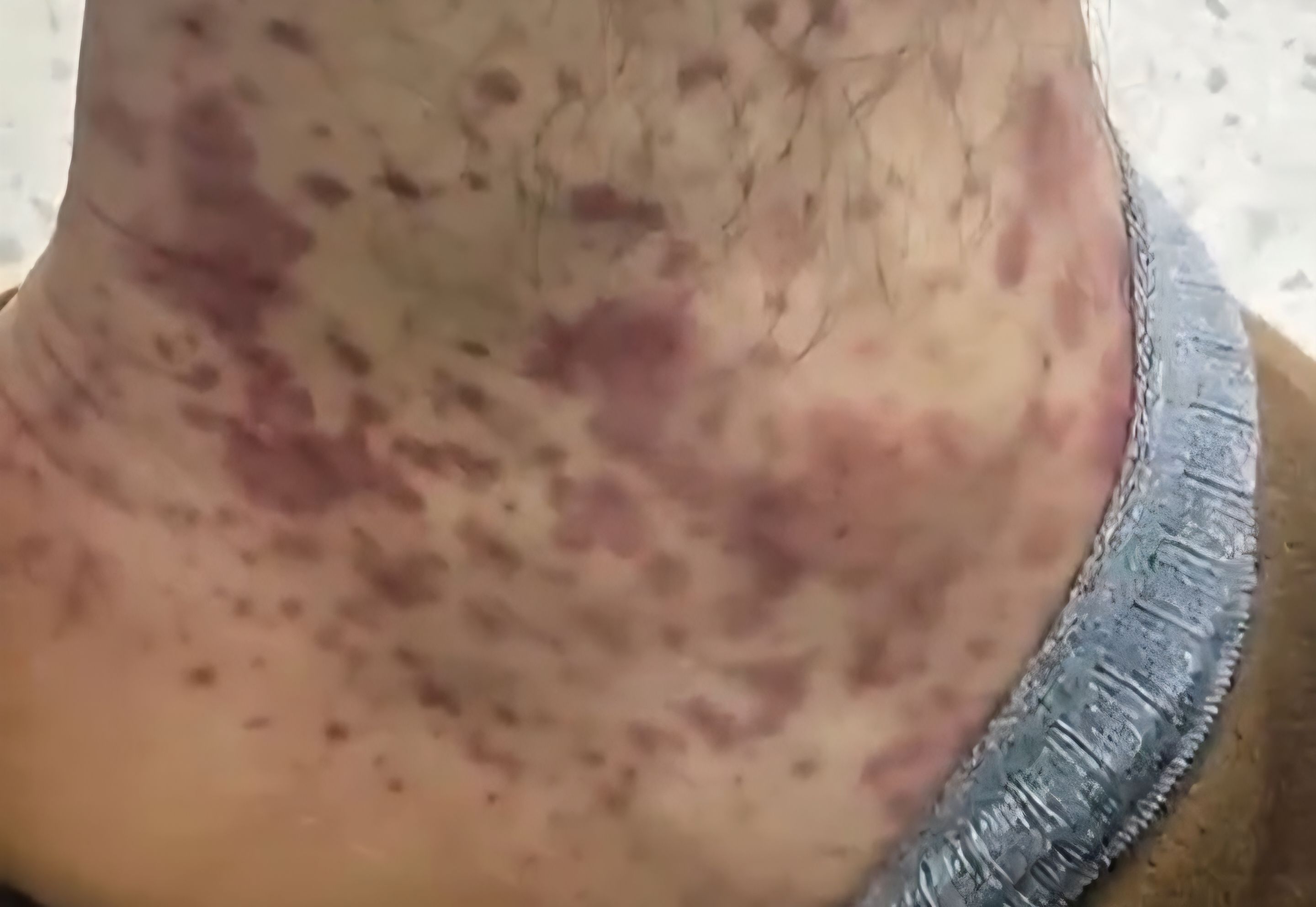 Qan durulaşdırıcı dərmanlardan ayağı bu hala düşdü -  VİDEO