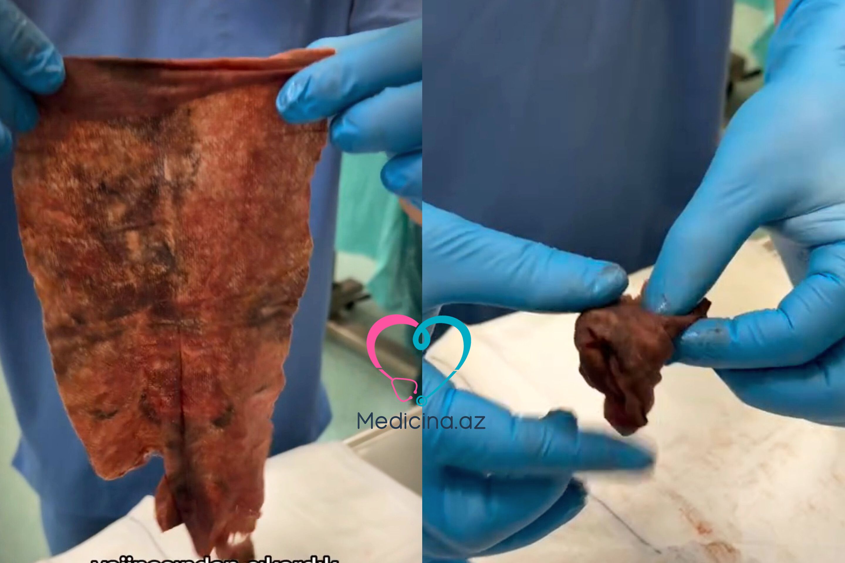 Vaginaya salfet qoyan qadın ağır infeksiyaya yoluxdu -  VİDEO