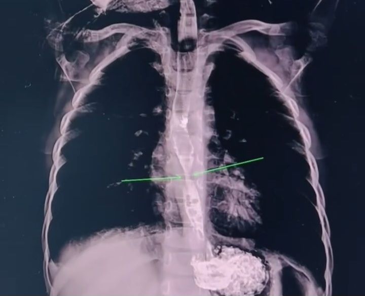 2 yaşlı uşaq yağ çözücü içdi - Daxili orqanları yandı -  VİDEO