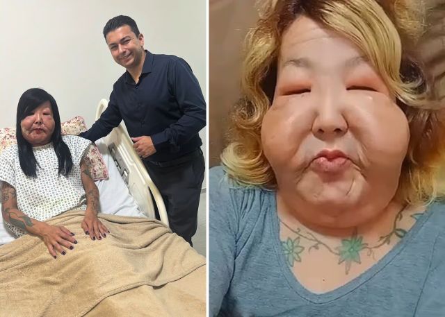 Gözəllik naminə üzü tanınmaz hala gəldi -  FOTO