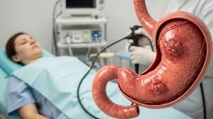 Bu qidalar mədə xərçəngini artırır 