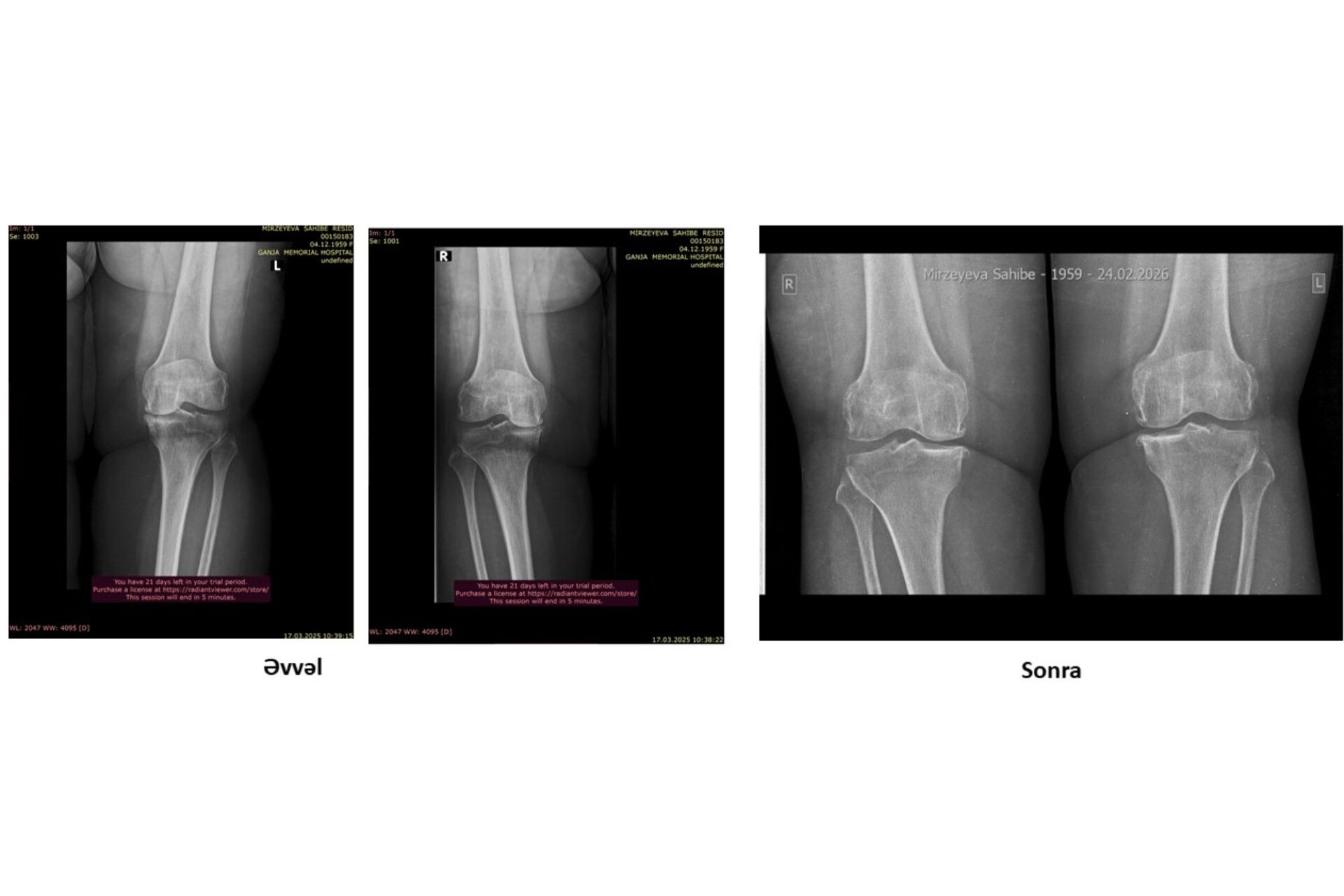 Protez təklif edildi, amma əməliyyatsız sağaldı –  Real pasiyent hekayəsi-VİDEO