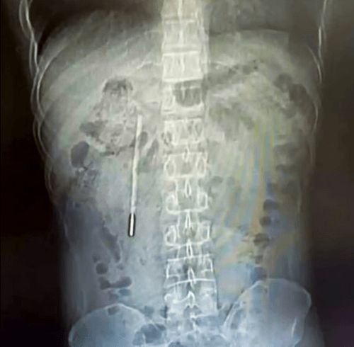 Uşaq vaxtı udduğu termometr  – 20 il sonra çıxarıldı