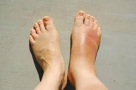 Topuq nahiyəsində şişkinlik və ağrı   - Səbəblər