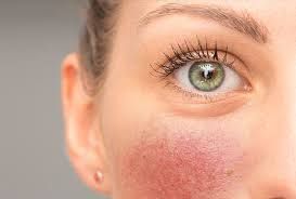 Qırmızı sifət  – Ürəyin xəstə olduğunu göstərir