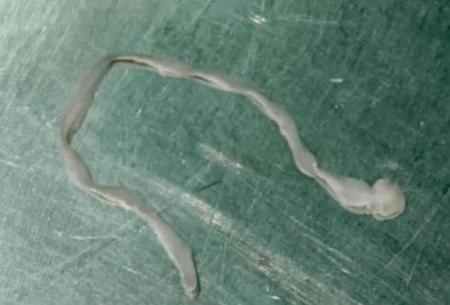 Qadının beynindən 8 santimetrlik    qurd çıxarıldı