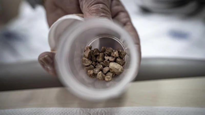 Qadının sidik kanalından 51 daş çıxarıldı -  Həkimlər şokda