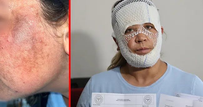 "Prenses baxımı" kabusa çevirdi -  Qadının üzü yandı-FOTO