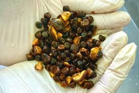 Öd kisəsində daş yaradan qaydalar 