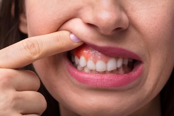 Diş ətiniz qanayırsa, bu vitamin  çatışmır 