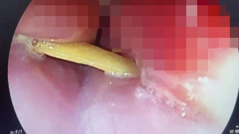 Ət yeyərkən ölümdən döndü -  Su da içə bilmirdi-FOTO