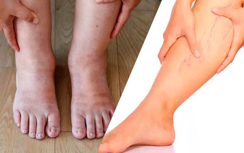Axşama doğru ayaqlar şişir və ağırlaşır? 