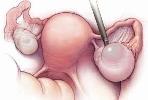 20 yaşlı qızdan qarpız böyüklükdə  kista çıxarıldı 