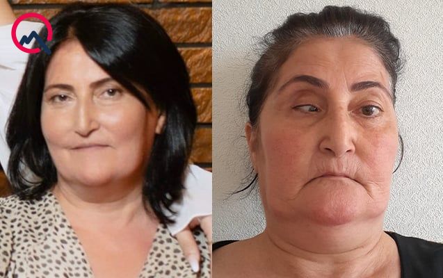 Bu klinika təzminat ödəyəcək -  Burun düzəldəndə gözü zədələyib