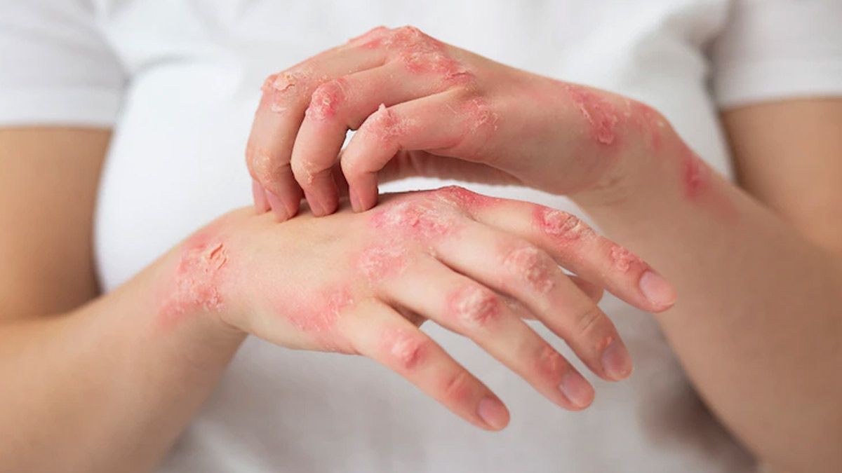 Dəri problemlərinin arxasında nə dayanır? -  Yüksəkdozalı Vitamin C ilə antioksidant müdafiəyə dəstək