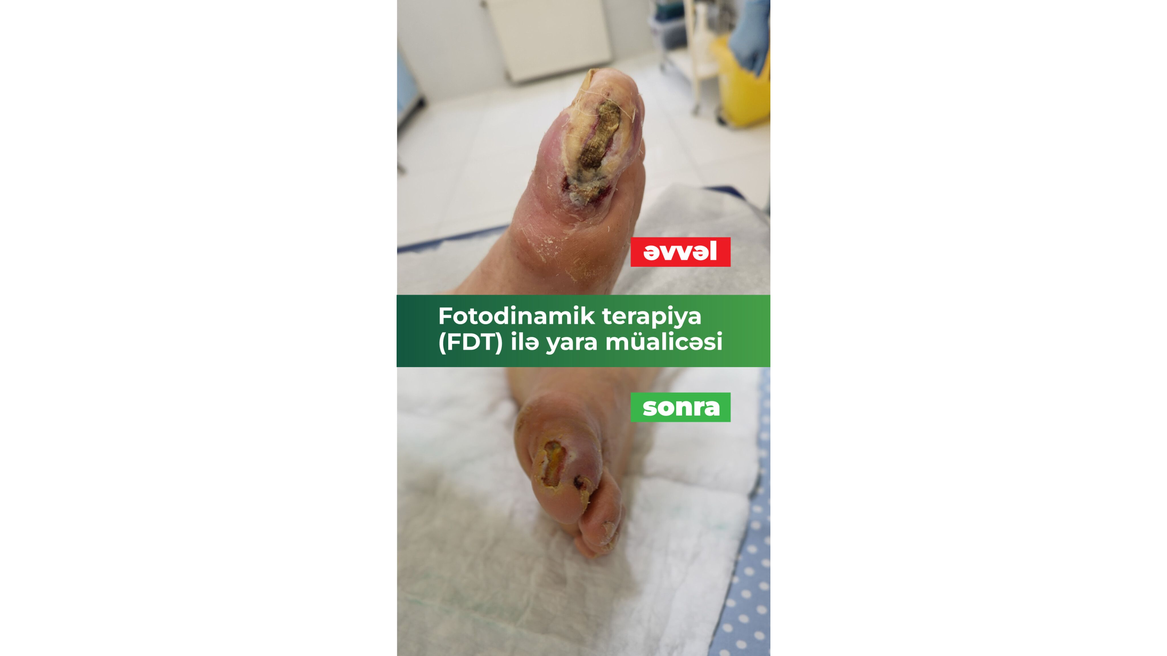 Ayağı kəsilməkdən xilas edən müalicə:  Fotodinamik terapiya (FDT) ilə diabetik yaralarda sürətli sağalma - VİDEO