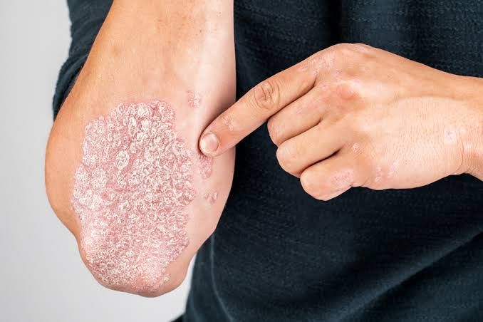 Psoriaz niyə təkrarlanır? -  Mütəxəssis səbəbləri açıqladı - VİDEO