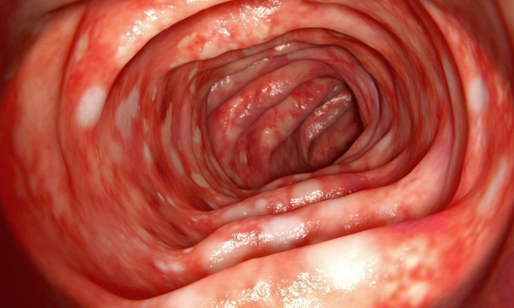 Xoralı Kolitə yeni yanaşma:  Gündə 16–20 dəfə ishal yaşayan xəstənin vəziyyətində dəyişiklik