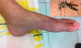 20 ilin ən güclü epidemiyası   - Çikunqunya qızdırması