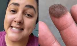 Dəri transplantasiyası olan qızın barmağından     tüklər çıxdı