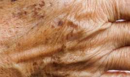 Gündə bir dəfə sürtün -  Qocalıq ləkələrini yox edir