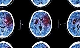 İnsultlar daha çox 55 yaşdan    aşağı qruplarda olur