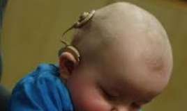  66 nəfərə koxlear implantasiya olunub 