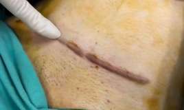 Kelleoid çapığı nədir? -  Həkimdən cavab