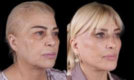 Mətanət İsgəndərlinin dəyişimi gündəm oldu -  FOTO