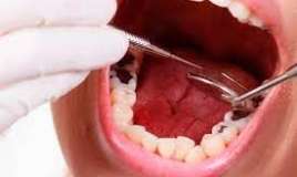 Çürük dişlər qida borusu xərçənginə  səbəb ola bilər