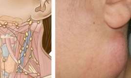 Boyunda şişmiş limfa düyünləri  –   Müalicəsi