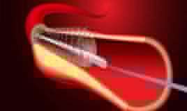 Stendlərin ömrü nə qədərdir? -  Kardioloqdan cavab