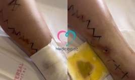 Daha bir qadın estetik prosedurun qurbanı oldu -  VİDEO