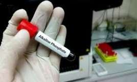 Ümumi qan analizi gizli sümük xəstəliyini göstərir 