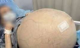 Qadının yumurtalığından 30 kiloqramlıq    şiş çıxardılar