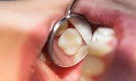  Çox saqqız çeynəmək dişlərdəki plombları boşaldır 