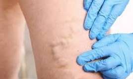  Ayaqlarda tromblar - Necə bilinir?