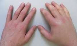 Əlləriniz tez-tez şişir  - Nəyi yoxladaq?