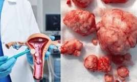 Uşaqlıqda mioma yarandısa  – Nə etməli?