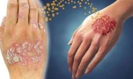 Psoriaz və ya pullu dəmrov - Niyə tam sağalmır?