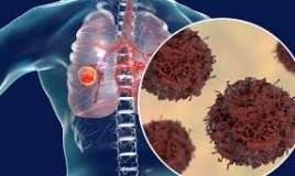 Kişilərdə ağciyər xərçəngi birinci yerdədir, səbəbi...  - Onkoloq  Vüsalə Tağıyeva