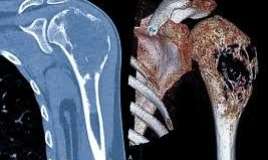 Xərçəngin sümüklərə yayılmasının əlamətləri 