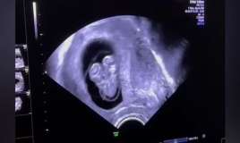 Azərbaycanda hamilədə Siam əkizləri görüldü - Video