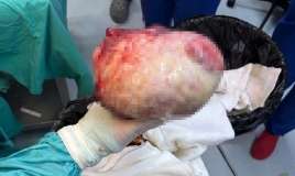 Qadının qarnından 6 kiloqramlıq kista çıxarıldı -  FOto