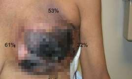 Əməkdar artistin əməliyyatdan sonra bədəni çürüyür?  