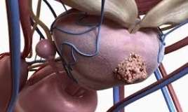 Kişilərdə bu aqressiv xərçəng genetikdir 