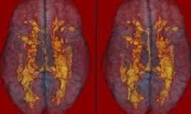 Balıq insulta səbəb ola bilərmi? 